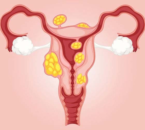 Impact of Fibroids on Pregnancy