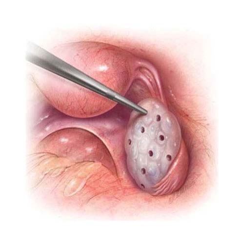 Laparoscopy and Hysteroscopy for Infertility