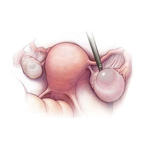 Ovarian surgeries